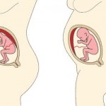 placenta placement