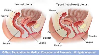 Sac ultrasound tilted uterus empty Retroverted/Tilted Uterus