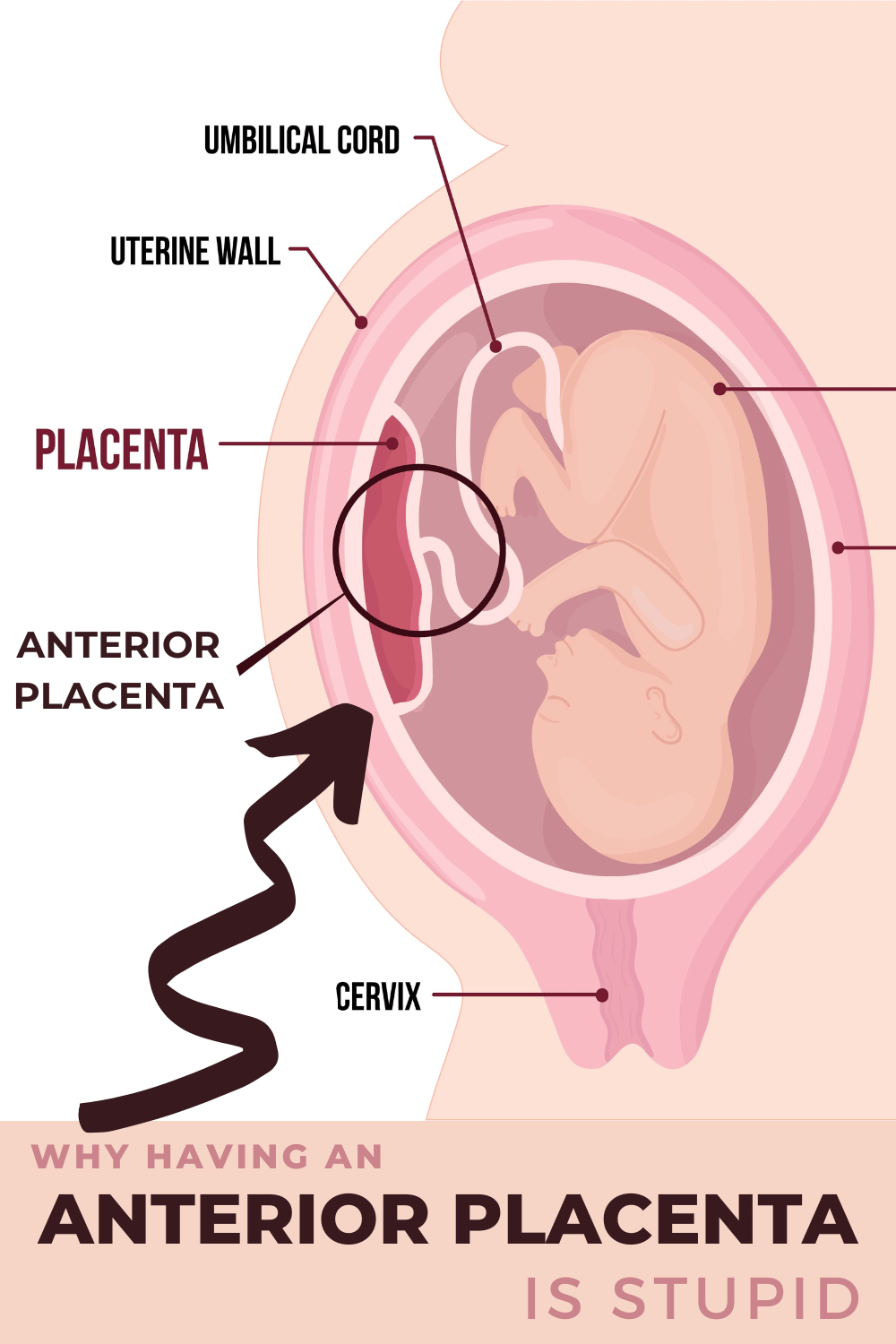 Diagram showing the location of an anterior placenta in the uterus during a pregnancy.