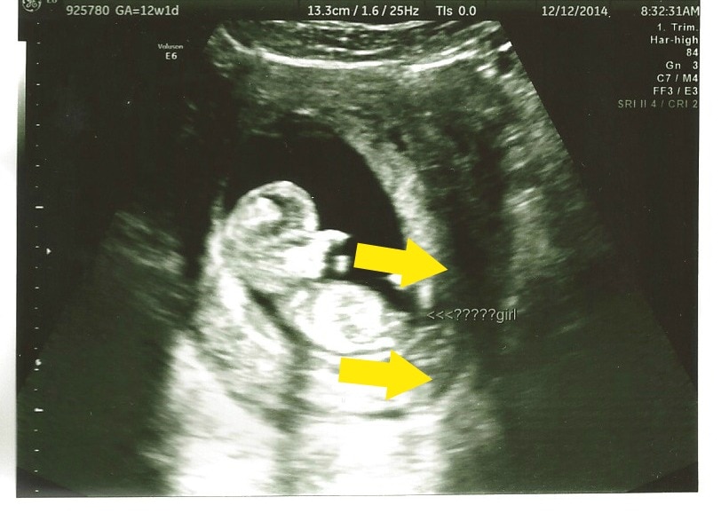 12 week ultrasound guessing gender girl