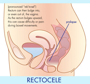 rectocele