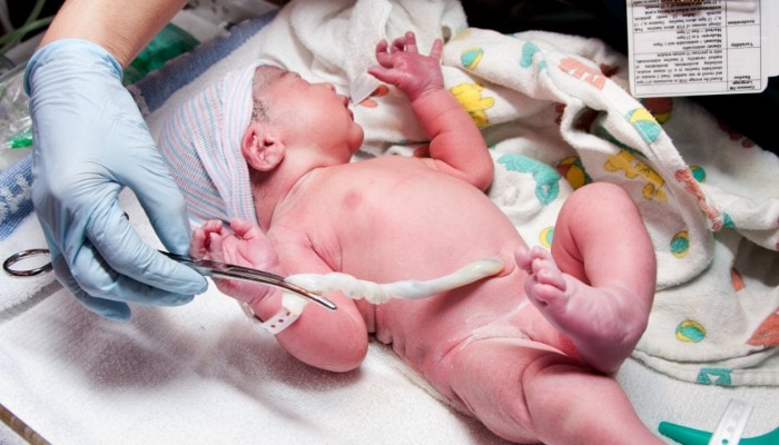 Umbilical cord milking is where the cord is pinched and "milked" immediately following birth in order to quickly push blood into the baby (as you would squeeze ketchup out of a packet, or honey out of a honey stick).  Starting as close to the placenta as possible, moving towards the baby, a care provider milks the cord several times before the cord is finally clamped and cut, usually within 20 seconds.  Umbilical cord milking is also sometimes called "stripping the cord".