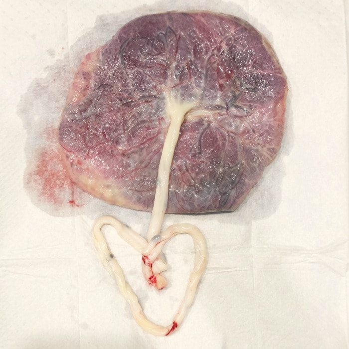 photo of placenta with cord in the shape of a heart