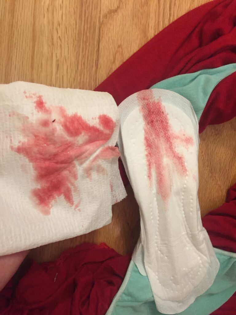 A mucus plug does not look like bloody show. This bloody show photo is light amounts of blood from the cervix opening. Bloody show is light colored, pink, and does not soak a pad.